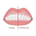 Gingival hyperplasia. Royalty Free Stock Photo